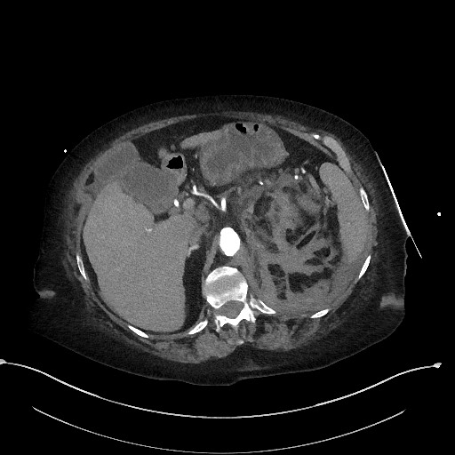 File:Active renal extravasation with large subcapsular and retroperitoneal hemorrhage (Radiopaedia 60975-68796 Axial C+ arterial phase 60).jpg
