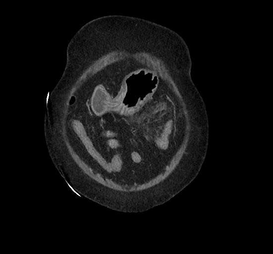 Active renal extravasation with large subcapsular and retroperitoneal hemorrhage (Radiopaedia 60975-68796 Coronal C+ portal venous phase 28).jpg