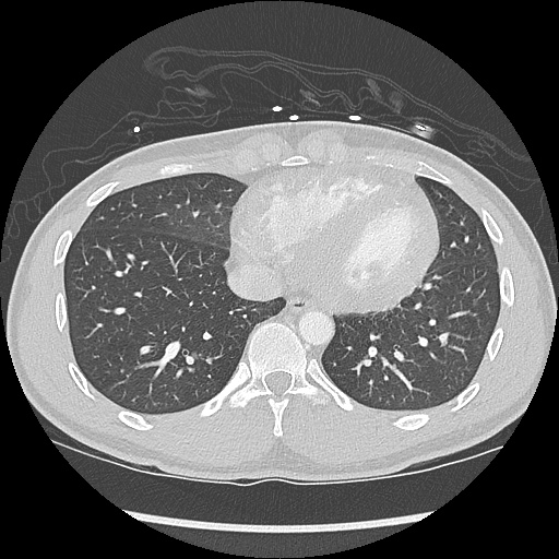 File:Active right ventricular cardiac sarcoidosis (Radiopaedia 55596-62101 Axial lung window 36).jpg