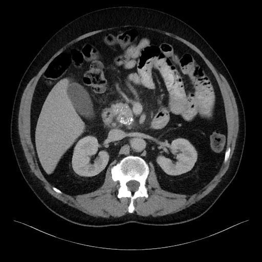 Acute-on-chronic pancreatitis (Radiopaedia 67286-76656 Axial C+ portal venous phase 31).jpg