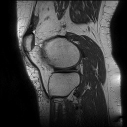 Acute-on-chronic transient lateral patellar dislocation with trochlear dysplasia (Radiopaedia 84099-99349 Sagittal PD 121).jpg