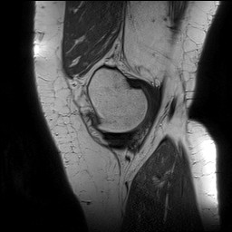 Acute-on-chronic transient lateral patellar dislocation with trochlear dysplasia (Radiopaedia 84099-99349 Sagittal PD 34).jpg