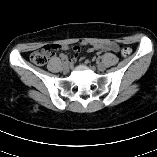 Acute appendicitis (Radiopaedia 30261-30888 Axial non-contrast 72).jpg