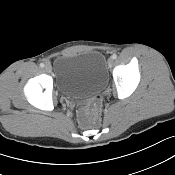 File:Acute appendicitis (Radiopaedia 32614-33572 Axial C+ portal venous phase 61).jpg