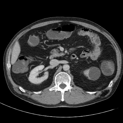 Acute appendicitis (Radiopaedia 66513-75790 Axial C+ portal venous phase 23).jpg