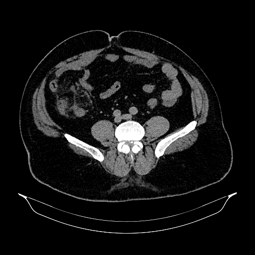 File:Acute appendicitis (Radiopaedia 79950-93224 Axial non-contrast 67).jpg