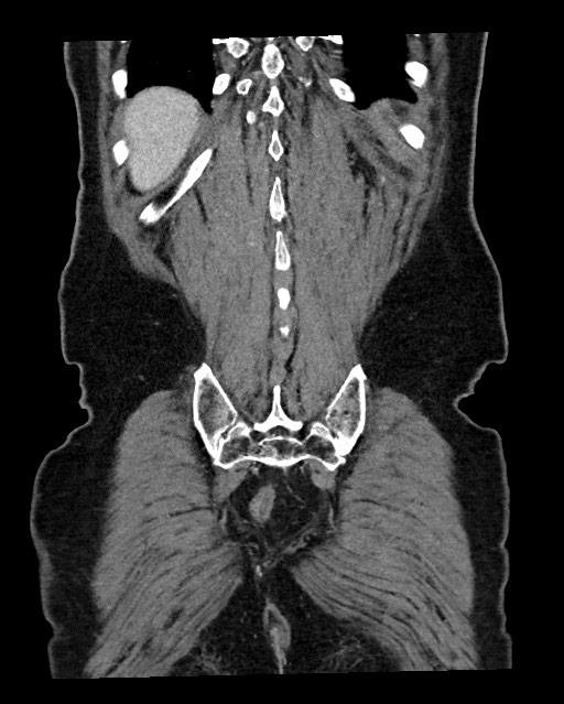 Acute appendicitis - large appendicoliths (Radiopaedia 61805-69820 Coronal C+ portal venous phase 116).jpg