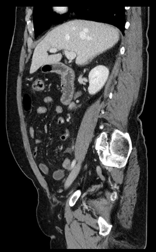 Acute appendicitis - large appendicoliths (Radiopaedia 61805-69820 Sagittal C+ portal venous phase 74).jpg