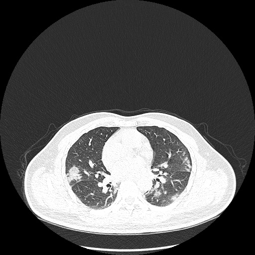 Acute appendicitis and COVID 19 pneumonia (Radiopaedia 76604-88380 Axial lung window 28).jpg