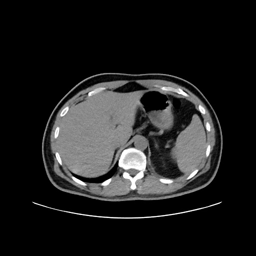 File:Acute appendicitis and COVID 19 pneumonia (Radiopaedia 76604-88380 Axial non-contrast 54).jpg