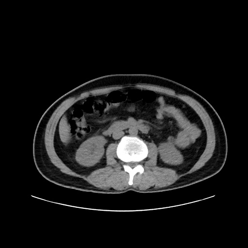 Acute appendicitis and COVID 19 pneumonia (Radiopaedia 76604-88380 Axial non-contrast 74).jpg