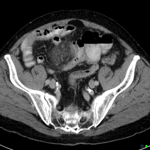 File:Acute appendicitis arising from a malrotated cecum (Radiopaedia 19970-19997 Axial C+ portal venous phase 36).jpg