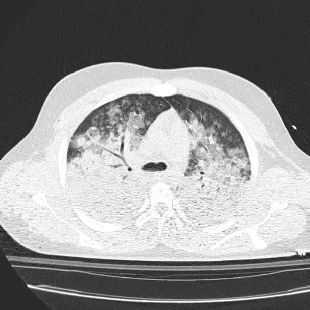 Acute aspiration pneumonitis (Radiopaedia 33605-34703 Axial lung window 37).jpg