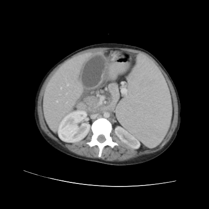 Acute calculous cholecystitis in patient with osteopetrosis (Radiopaedia 77871-90159 Axial C+ portal venous phase 40).jpg
