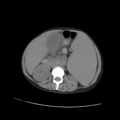 File:Acute calculous cholecystitis in patient with osteopetrosis (Radiopaedia 77871-90159 Axial non-contrast 41).jpg
