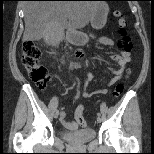 Acute cholecystitis and ureteric colic (Radiopaedia 42330-45444 Coronal prone 46).jpg