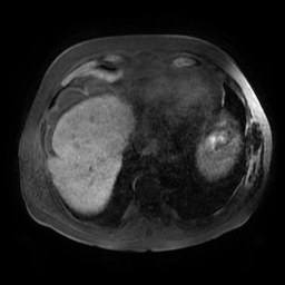 Acute cholecystitis complicated by pylephlebitis (Radiopaedia 65782-74915 Axial T1 fat sat 5).jpg