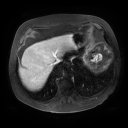 Acute cholecystitis complicated by pylephlebitis (Radiopaedia 65782-74915 Axial arterioportal phase T1 C+ fat sat 12).jpg