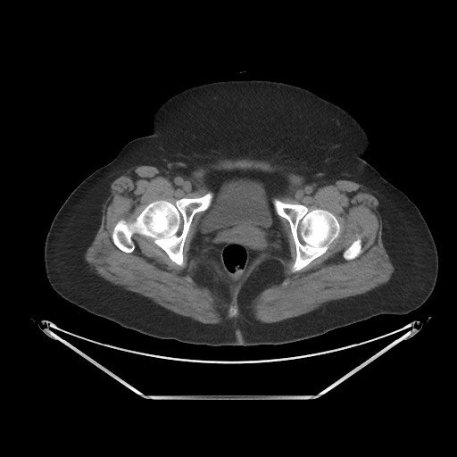 File:Acute cholecystitis with tensile fundus sign (Radiopaedia 71394-81723 Axial non-contrast 114).jpg
