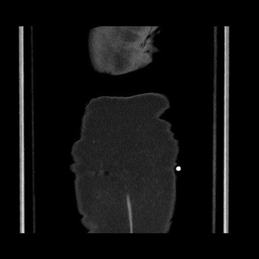 Acute cholecystitis with tensile fundus sign (Radiopaedia 71394-81723 Coronal non-contrast 127).jpg