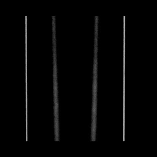 Acute cholecystitis with tensile fundus sign (Radiopaedia 71394-81723 Coronal non-contrast 138).jpg