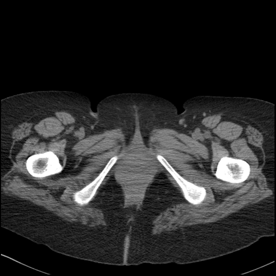 Acute colonic hemorrhage in ulcerative colitis (Radiopaedia 77415-89538 Axial non-contrast 146).jpg