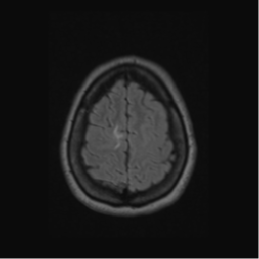 Acute disseminated encephalomyelitis (ADEM) (Radiopaedia 38073-40065 Axial FLAIR 57).png
