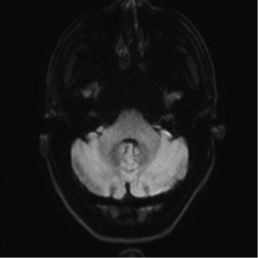 File:Acute disseminated encephalomyelitis (ADEM) (Radiopaedia 65319-74350 Axial DWI 5).png