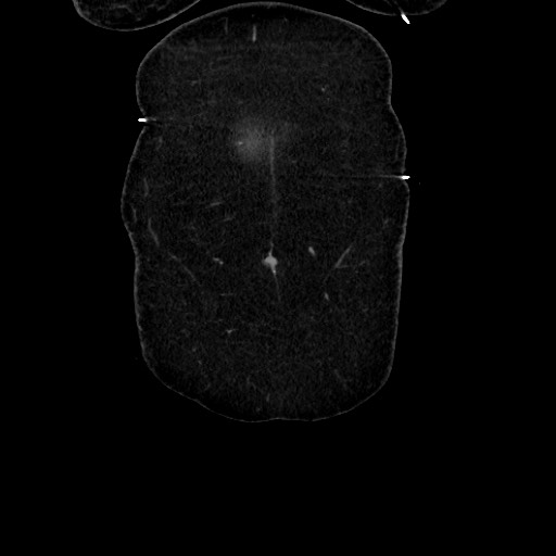 Acute diverticulitis - transverse colon (Radiopaedia 87063-103327 Coronal C+ portal venous phase 28).jpg