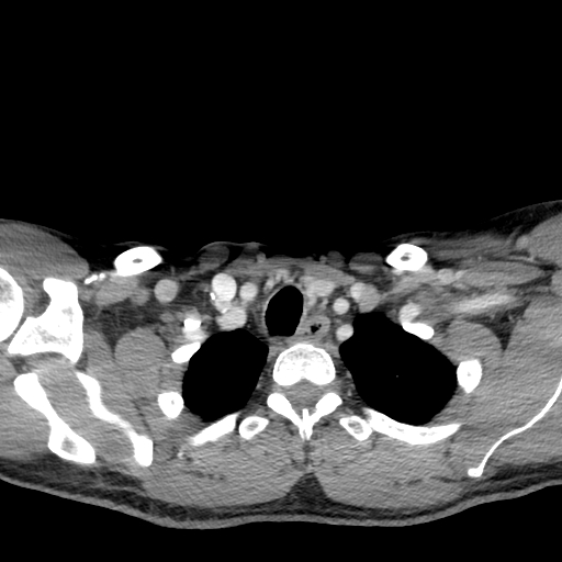 Acute longus colli calcific tendinitis (Radiopaedia 72495-83036 Axial C+ arterial phase 82).jpg