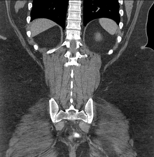 Acute mesenteric venous ischemia (Radiopaedia 46041-50383 Coronal C+ portal venous phase 78).jpg