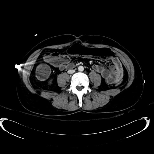 Acute myocardial infarction in CT (Radiopaedia 39947-42415 Axial C+ portal venous phase 75).jpg