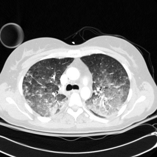 Acute myocardial infarction in CT (Radiopaedia 39947-42415 Axial lung window 42).jpg