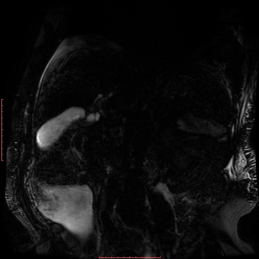 File:Acute necrotizing pancreatitis (Radiopaedia 28194-28448 Coronal MRCP 33).jpg
