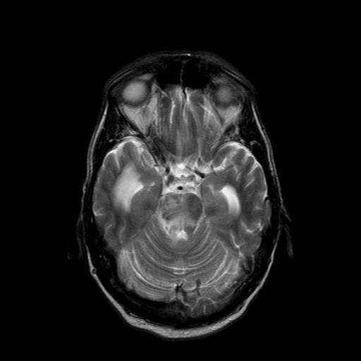 File:Acute necrotizing toxoplasma encephalitis (Radiopaedia 10683-11149 Axial T2 12).jpg