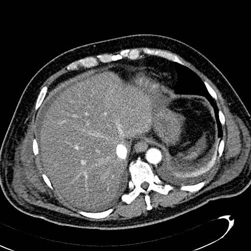 File:Acute pancreatic necrosis (Radiopaedia 13560-13486 Axial C+ portal venous phase 27).jpg