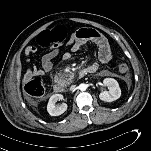 File:Acute pancreatic necrosis (Radiopaedia 13560-13486 Axial C+ portal venous phase 69).jpg