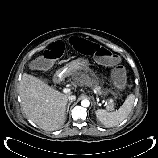 Acute pancreatic necrosis (Radiopaedia 13560-18500 Axial C+ portal venous phase 45).jpg