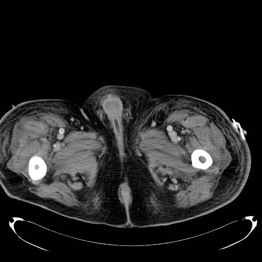 Acute pancreatic necrosis (Radiopaedia 13560-18503 Axial C+ portal venous phase 95).jpg
