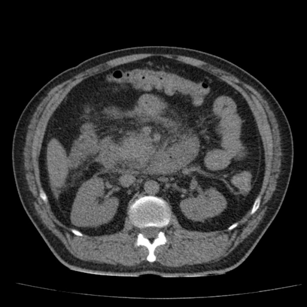 Acute pancreatitis (Radiopaedia 26663-26813 Axial non-contrast 44).jpg