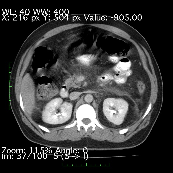 File:Acute pancreatitis (Radiopaedia 34043-35276 Axial C+ portal venous phase 37).jpg