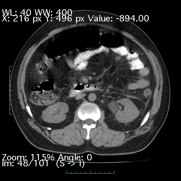 Acute pancreatitis (Radiopaedia 34043-35276 Axial non-contrast 48).jpg