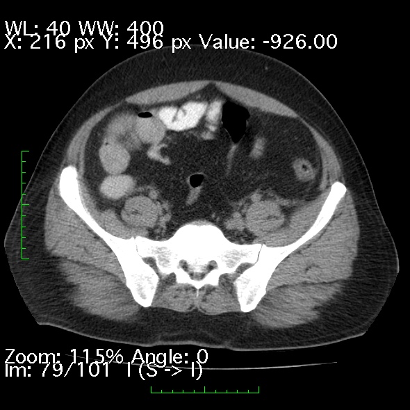 Acute pancreatitis (Radiopaedia 34043-35276 Axial non-contrast 79).jpg