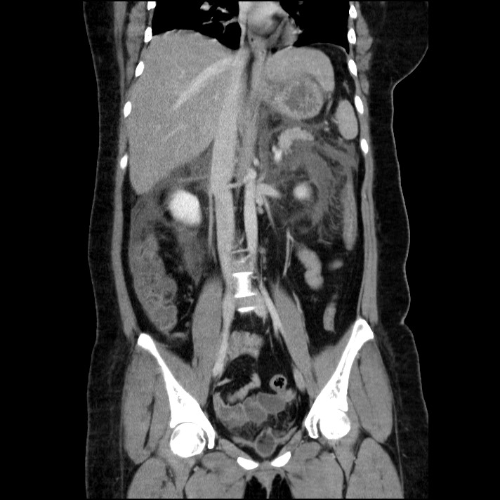 Acute pancreatitis (Radiopaedia 69236-79012 Coronal C+ portal venous phase 38).jpg