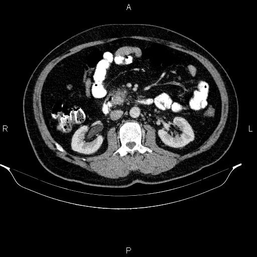 Acute pancreatitis (Radiopaedia 85390-101010 Axial C+ portal venous phase 48).jpg