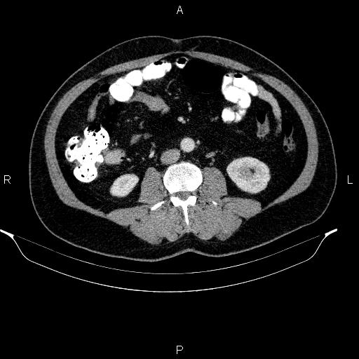 Acute pancreatitis (Radiopaedia 85390-101010 Axial C+ portal venous phase 59).jpg