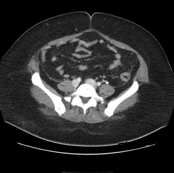 File:Acute pancreatitis - Balthazar E (Radiopaedia 29016-29377 Axial C+ portal venous phase 50).png