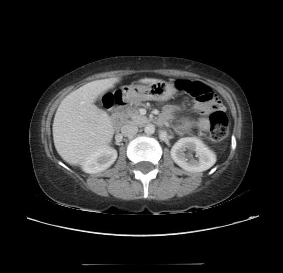 Acute pancreatitis - Balthazar E - post ERCP (Radiopaedia 27562-27772 Axial C+ portal venous phase 30).png