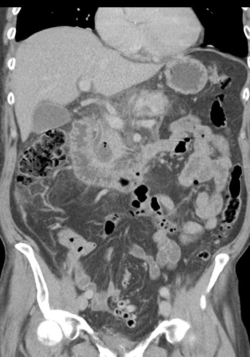 Acute pancreatitis and walled-off necrosis (Radiopaedia 29888-30403 E 26).jpg