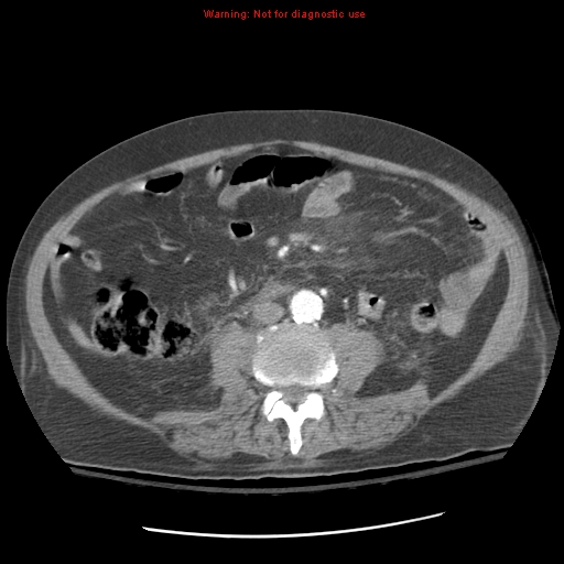 Acute pancreatitis with incidental pancreatic lipoma (Radiopaedia 10190-10730 Axial C+ arterial phase 62).jpg